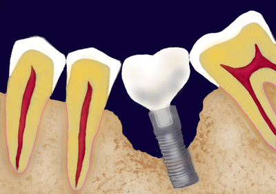 Dental Implant Disease?
